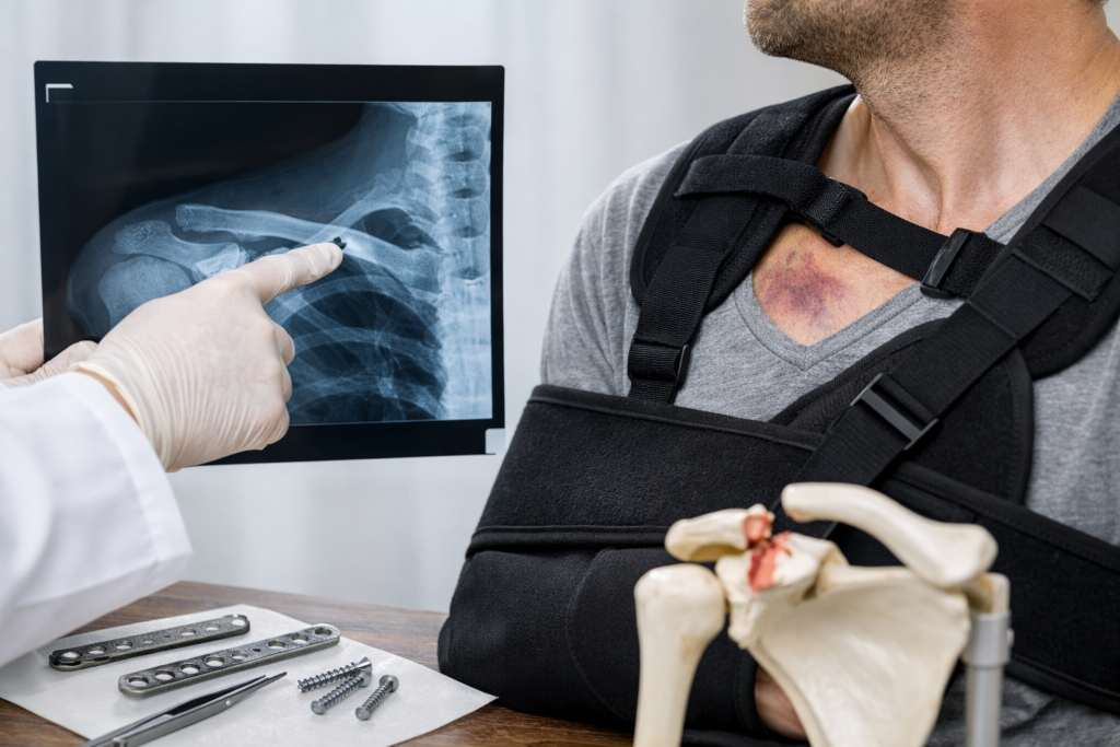 frattura clavicola